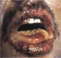 The mouth of a man who has suffered a 10 to 20 Gy dose 21 days after the exposure, note that damage to normal skin, the lips and the tongue can be seen