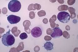 chronic myeloid leukemia cells