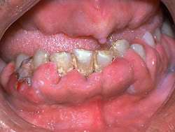 hyperplasia of the gums