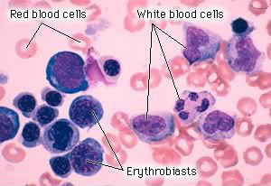 leukemia_cells_pcf-cut.jpg