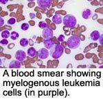 myelogenous leukemia cells in purple