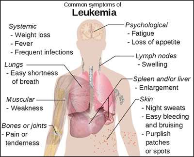 symptoms of leukemia